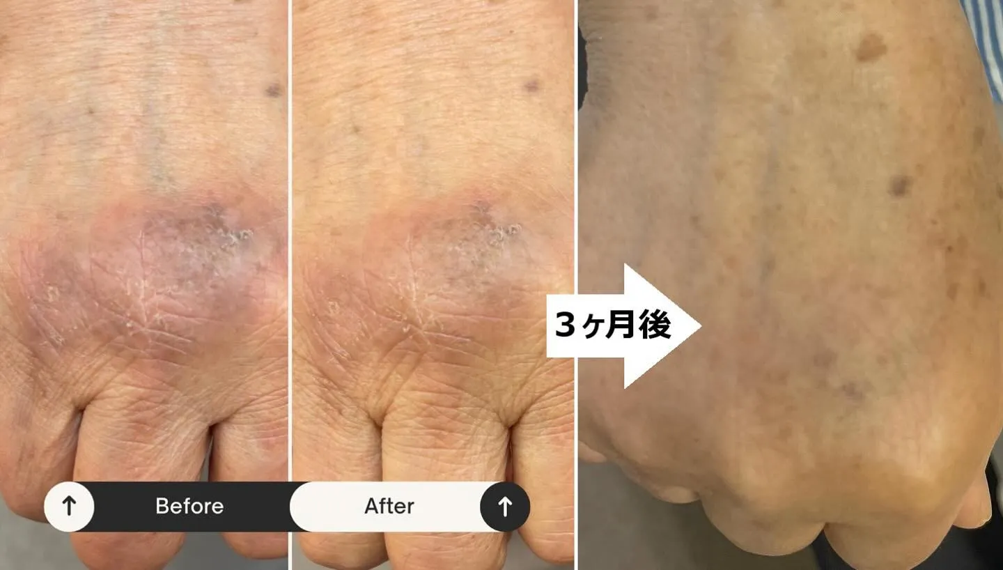 右手の甲の「かゆみ」が続いていた患者様が、定期的に施術を受け...